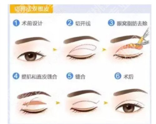 魏少魁医生双眼皮修复怎么样?在线查看技术优势