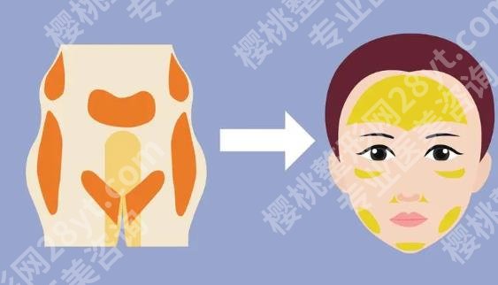 上海玻尿酸填充加瘦脸大概多少钱?效果可以维持多长时间?