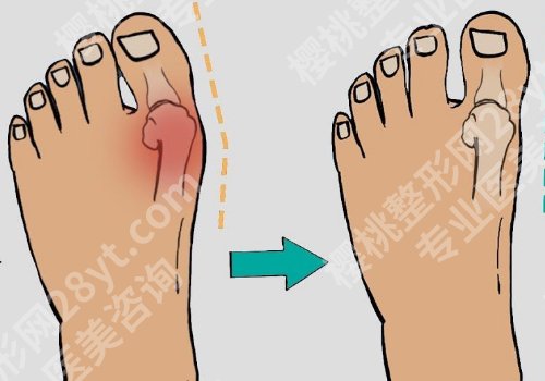 北京圣嘉新拇外翻技术好吗?医院介绍、案例详情来袭