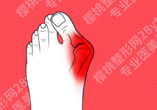北京圣嘉新拇外翻技术好吗?医院介绍、案例详情来袭