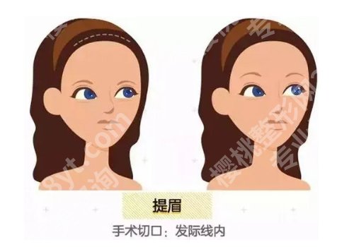 吴丽丽医生提眉怎么样?详细介绍、口碑点评、明星项目