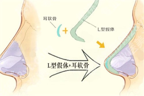 刘安堂鼻综合做的好吗?隆鼻案例分享