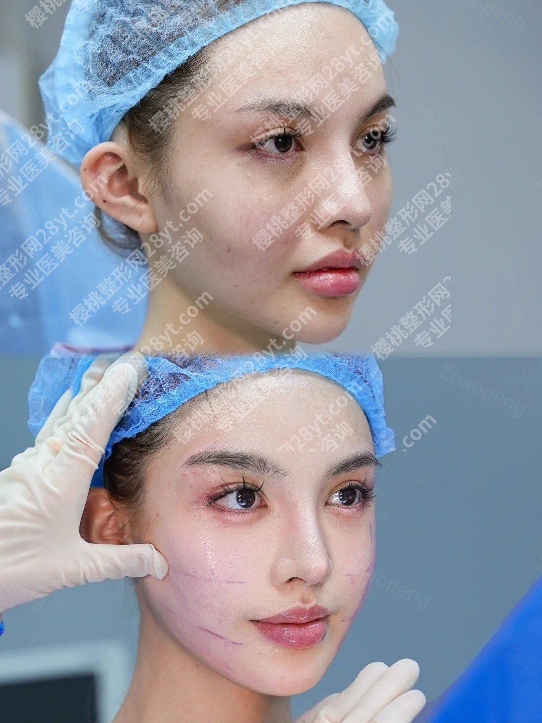 九院金云波面部提升失败修复案例图展示!来看前后对比图!