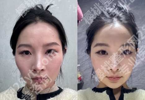 颧骨内推国内名气比较大的医生推荐!柳超、李志海、何照华等实力不俗!