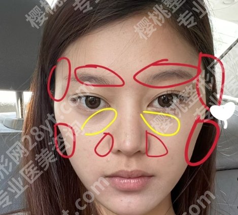 北京颧骨内推好的专家有哪些?黄大勇、何照华、张笑天等技术可靠!
