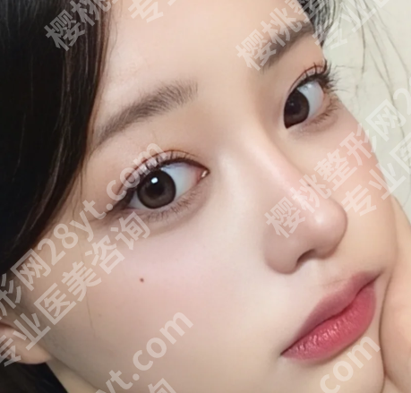 徐怀河双眼皮怎么样?了解口碑医生介绍,含经典案例过程