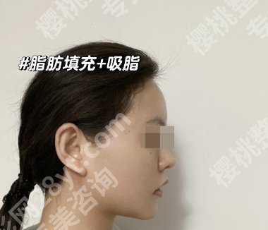 邯郸脂肪填充哪家好?附各医院详细资料供大家参考哦!