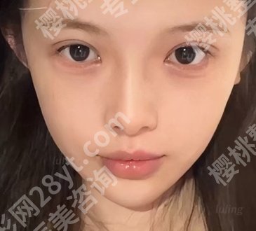 上海八院医美科怎么样?戳进来看真人做双眼皮手术项目案例!