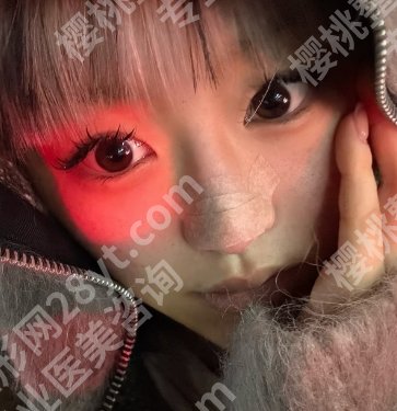 成都八大处隆鼻怎么样?于晓波vs章庆国技术对比!鼻部案例参考