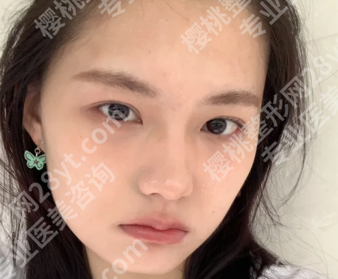 郑倞旻眼底四项技术怎么样?公开案例步骤一览