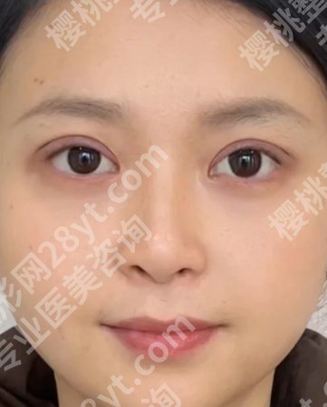 北京积水潭医院刘岩医生双眼皮做的好吗?医生信息、顾客点评、真实案例分享