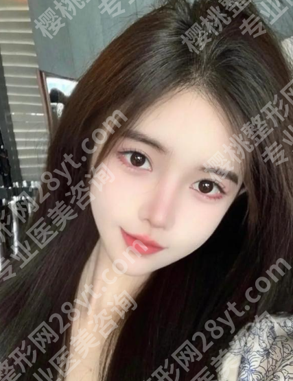 杨莉亚医生案例更新!医生介绍、价格表、术后小tips