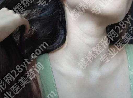 卢九宁医生做斜颈手术怎么样?含案例过程详情