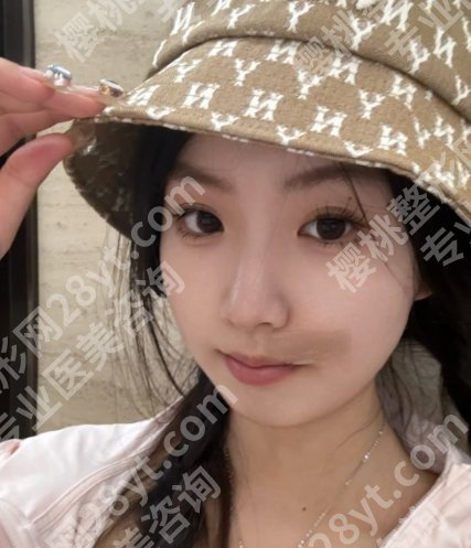 孙娜娜医生切痣怎么样?医生介绍及明星项目分享