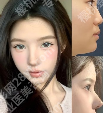成都华西做鼻综合怎么样?医院人气医生推荐!案例分享