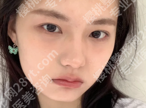 武汉卓田割的双眼皮怎么样啊?速看案例详情一览