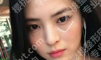 上海六院祛眼袋专家都有谁?郭峰、邓辰亮、茅广宇凭实力上榜!