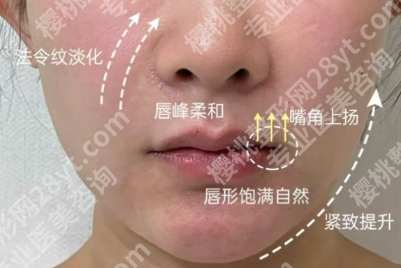 合肥全脸填充大概多少钱?2025价格一览+医院top5名单介绍!
