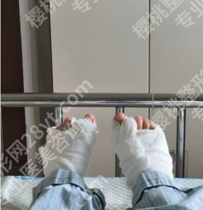 孙逸仙整形外科做并趾手术咋样?医院口碑评价+真实案例图展示!