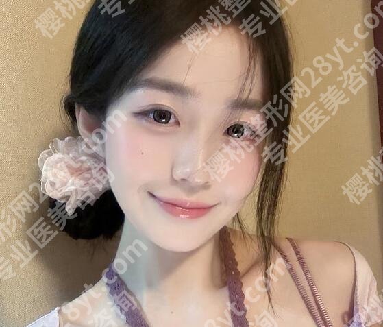 袁文达医生案例图展示!真人去眼袋术后对比图分享!见证美丽蜕变