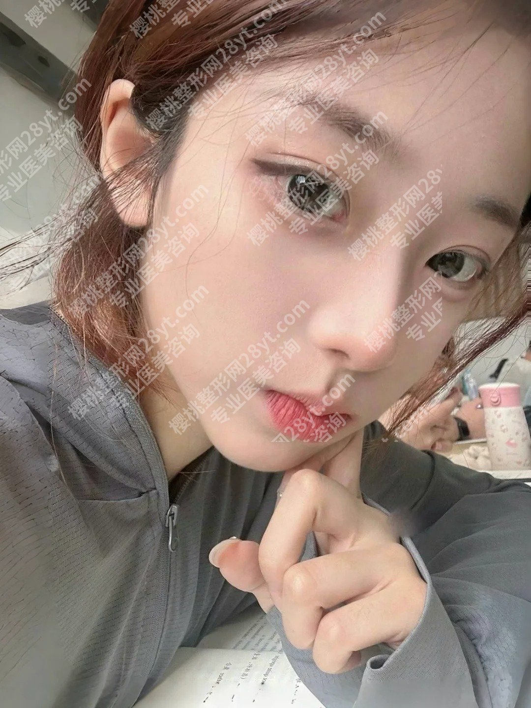 ***医生做双眼皮手术咋样?明星项目和案例鉴赏