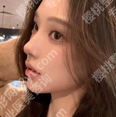 罗志敏医生隆鼻案例图片怎么样?面诊一一查看,案例过程查看