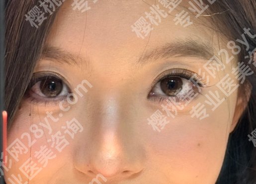 哈尔滨瑞丽做双眼皮怎么样?多少钱?附院内详细介绍,性价比高