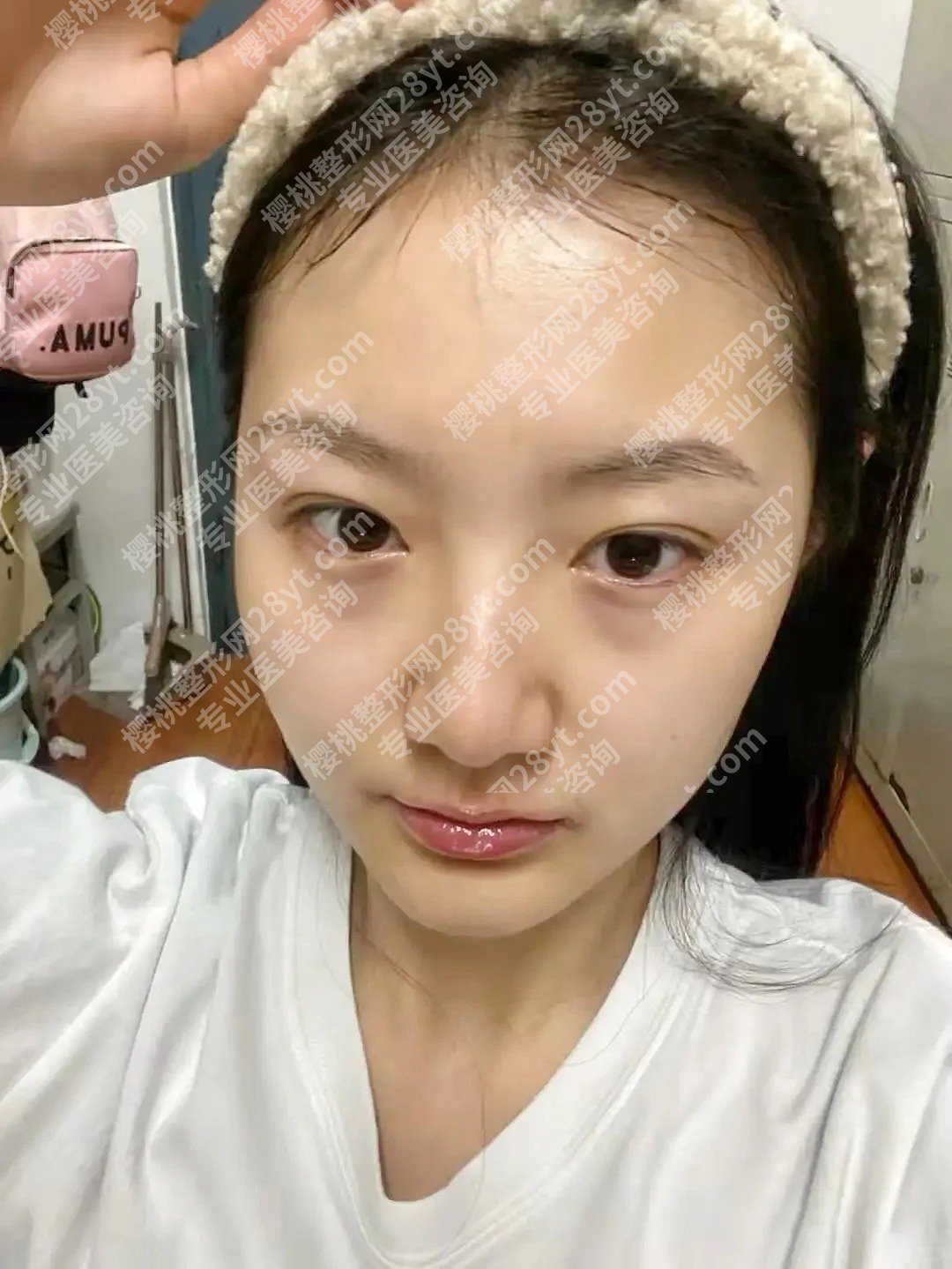 吴乐昊医生眼袋手术怎么样了呀?医生简介网友反馈和擅长项目了解
