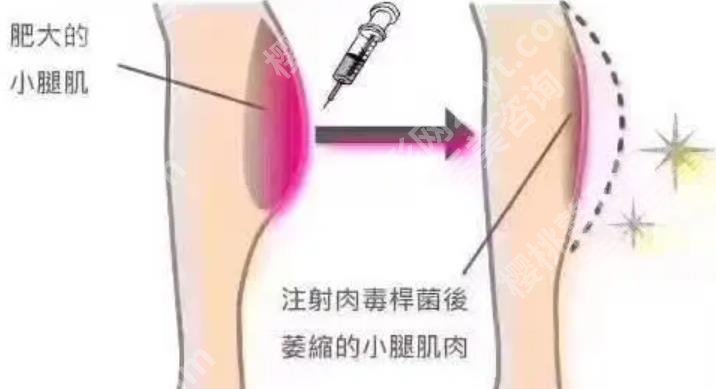 重庆瘦腿医院哪家做的好?各医院代表医生推荐给大家!