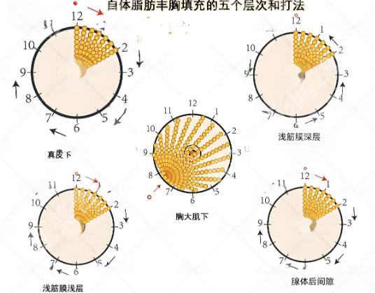 青岛大学附属医院隆胸多少钱?隆胸价格为9878元起