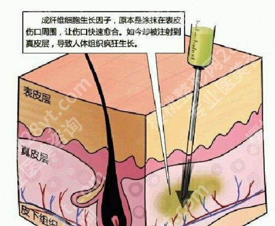 齐云香取生长因子效果怎么样?技术可靠吗?有谁做过