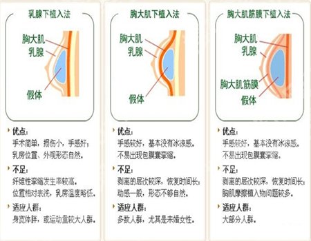 曾昂做的隆胸术怎么样?案例过程查看,技术分析