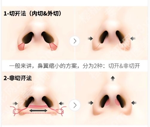 徐威做鼻子好看吗?风格自然吗?网友亲身经历附上!