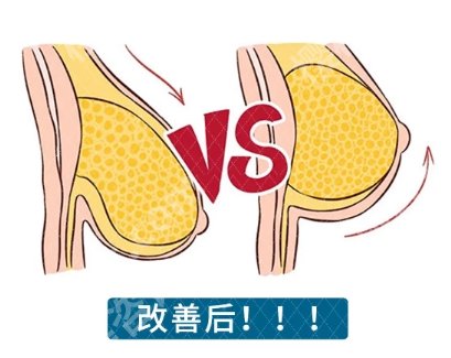 沈正宇做胸部悬吊术怎么样?技术测评|擅长项目介绍!