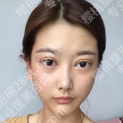 韩岩修复双眼皮怎么样?医生简介、核心项目更新!