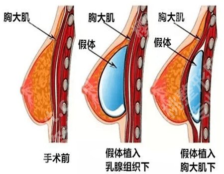 丁庆丰隆胸技术如何?面诊过程公开,详情点击查看