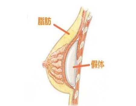 李湘原医生假体隆胸怎么样?技术水平怎么样?在线了解