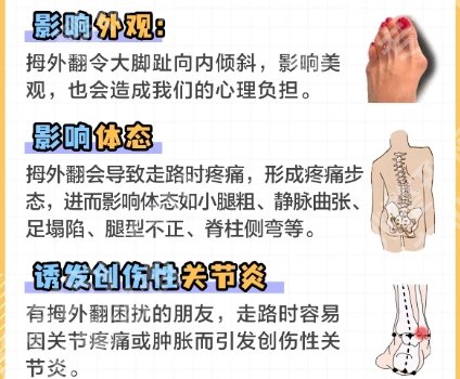北京苏敬达大脚骨手术怎么样?医生实力技术精准!