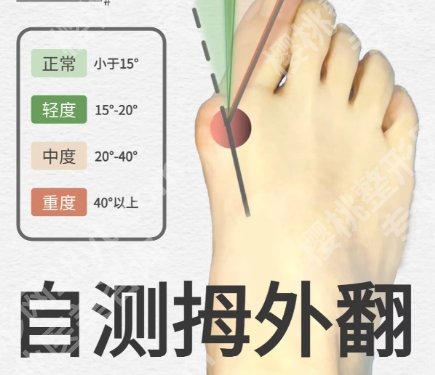 北京苏敬达大脚骨手术怎么样?医生实力技术精准!