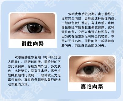 葛海辉双眼皮案例图展示！见证网友美丽蜕变！戳进来看