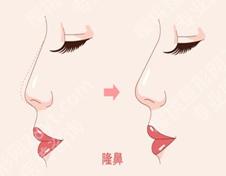 杭州张建文医生鼻子案例怎么样?隆鼻案例详情戳进来看