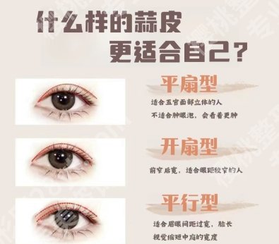 侯文明做眼睛怎么样?做双眼皮技术好不好?案例展示!
