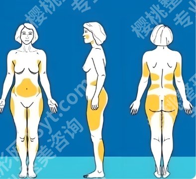 成都怡脂医疗效果怎么样?做吸脂技术如何?案例鉴赏!
