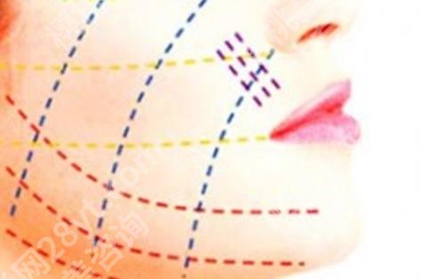 成都赵延峰面部提升怎么样？技术好吗？戳进来看实例