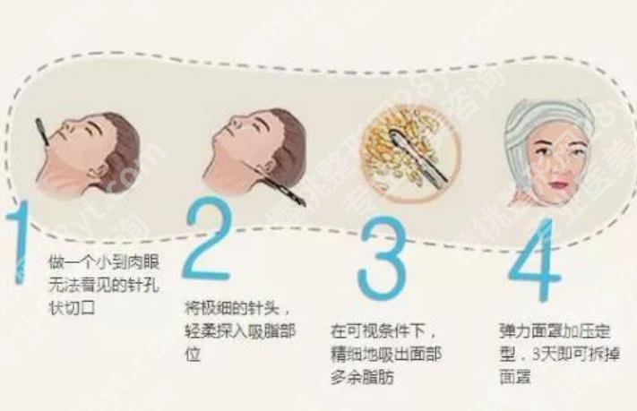 广医一院面部吸脂多少钱？医院吸脂技术优势剖析！