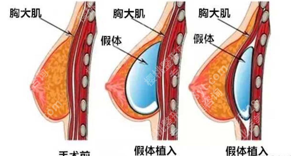 南京友谊医院隆胸专家哪位技术好？戳进来看用户口碑