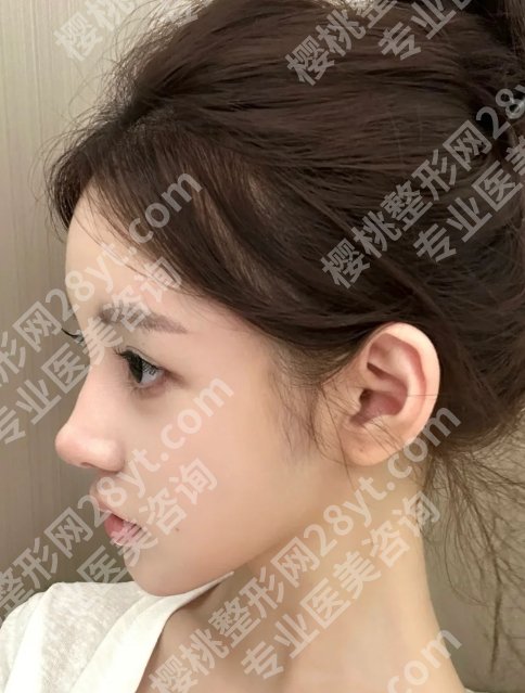 刘波医生做的植皮鼻翼缘会回缩吗?技术特色、25年价格一览!