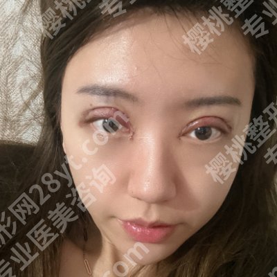 北京卢建建双眼皮修复案例!附医生资料、技术特色!