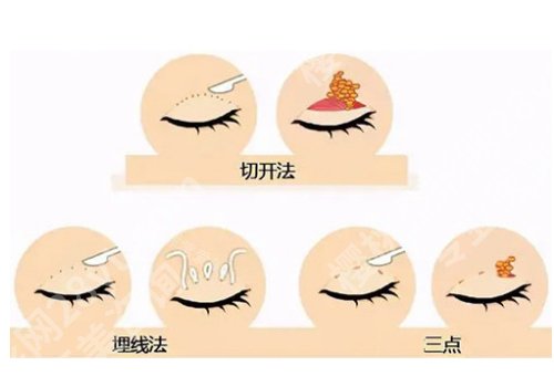 广州武警医院割双眼皮多少钱?低至6200元起!好评如潮!