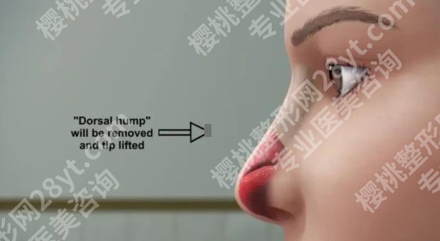 成都华西医院隆鼻假体取出技术如何?真实案例鉴赏